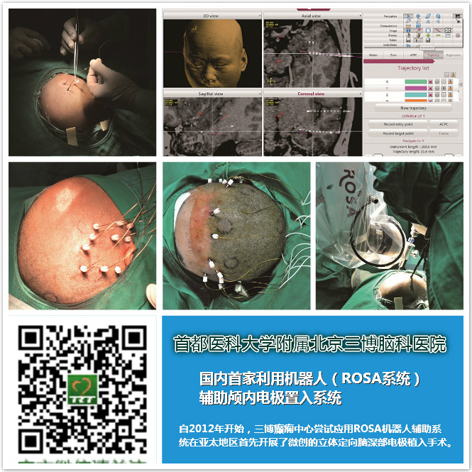 機(jī)器人無(wú)框架立體定向腦深部電極置入手術(shù)