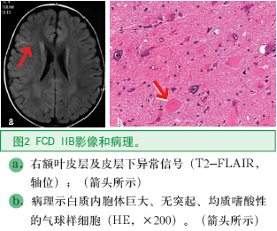 圖2 FCD IIB影像和病理。