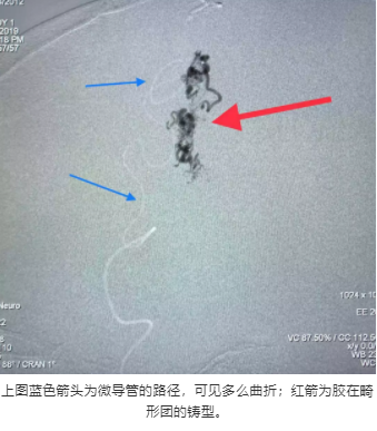 上圖藍(lán)色箭頭為微導(dǎo)管的路徑，可見多么曲折；紅箭為膠在畸形團(tuán)的鑄型。