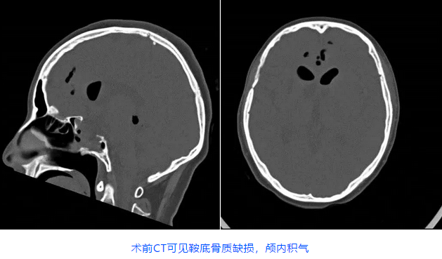 術(shù)前CT可見鞍底骨質(zhì)缺損，顱內(nèi)積氣