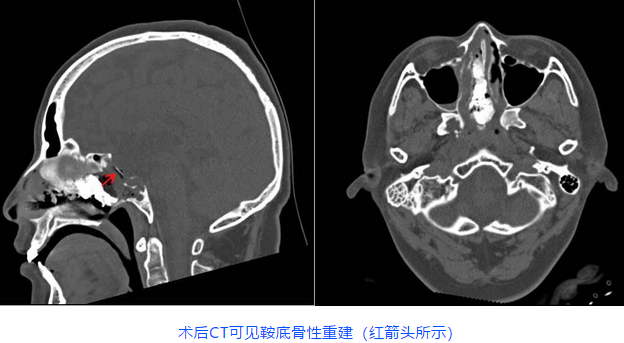 術(shù)后CT可見鞍底骨性重建(紅箭頭所示)