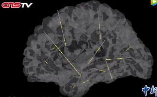 精準深入大腦深處 創(chuàng)傷小效率高，確定癲癇病灶