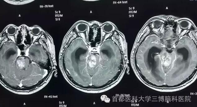 中腦膠質(zhì)瘤