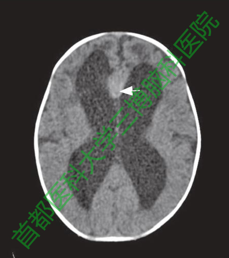 圖1手術(shù)前頭CT。箭頭示縱裂池內(nèi)稍高密度病灶。