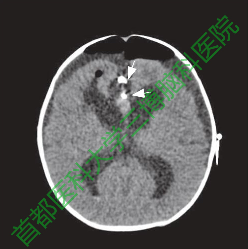 圖5手術(shù)后20小時(shí)頭CT。腦室較手術(shù)前變小。白色箭頭示動(dòng)脈瘤夾。