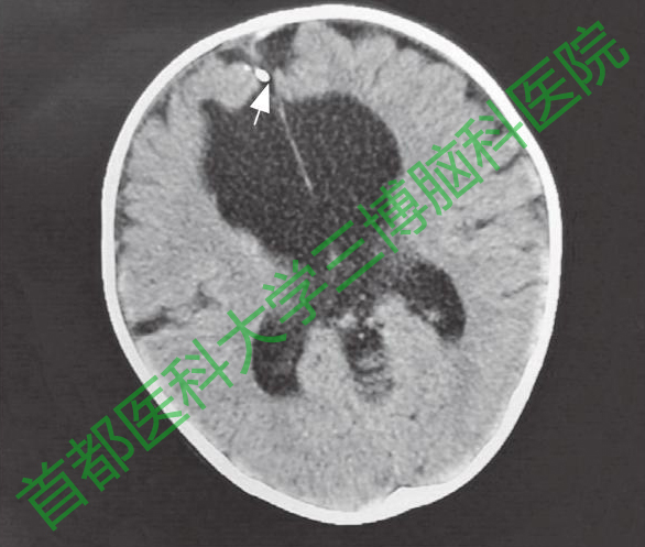 圖6手術(shù)后20個(gè)月復(fù)查頭CT，腦室仍有擴(kuò)張。白色箭頭示動(dòng)脈瘤夾。
