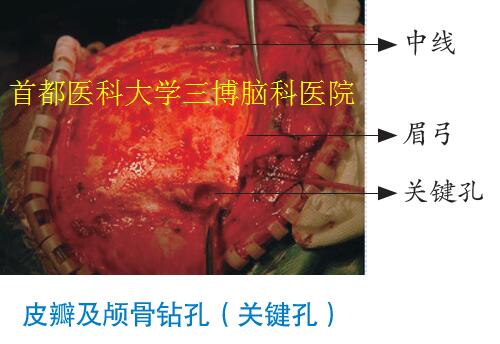 皮瓣及顱骨鉆孔（關(guān)鍵孔）