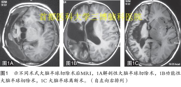 圖1 示不同術(shù)式大腦半球切除術(shù)后MRI，1A解剖性大腦半球切除術(shù)，1B功能性 大腦半球切除術(shù)，1C 大腦半球離斷術(shù)。（自左向右排列）