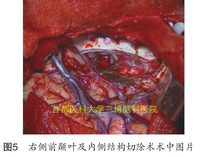 圖5 右側(cè)前顳葉及內(nèi)側(cè)結(jié)構(gòu)切除術(shù)術(shù)中圖片