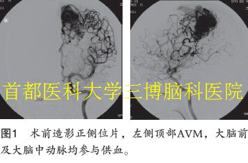 圖1 術(shù)前造影正側(cè)位片，左側(cè)頂部AVM，大腦前 及大腦中動(dòng)脈均參與供血