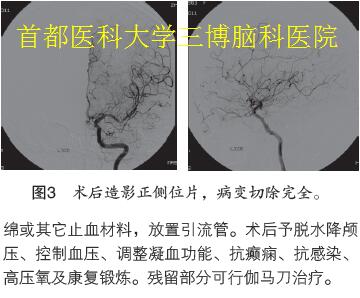 圖3 術(shù)后造影正側(cè)位片，病變切除完全