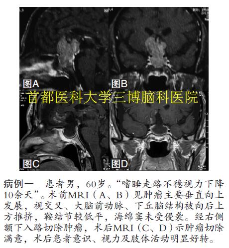 病例一