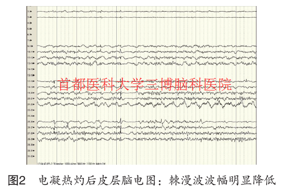 圖2 電凝熱灼后皮層腦電圖：棘漫波波幅明顯降低
