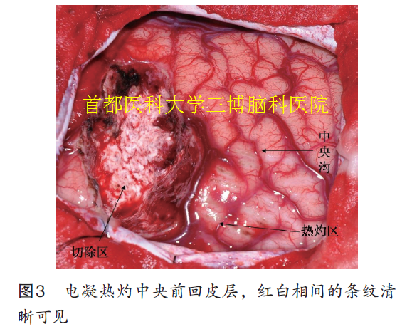 圖3 電凝熱灼中央前回皮層，紅白相間的條紋清 晰可見