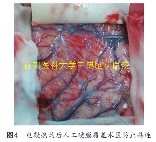 圖4 電凝熱灼后人工硬膜覆蓋術(shù)區(qū)防止粘連