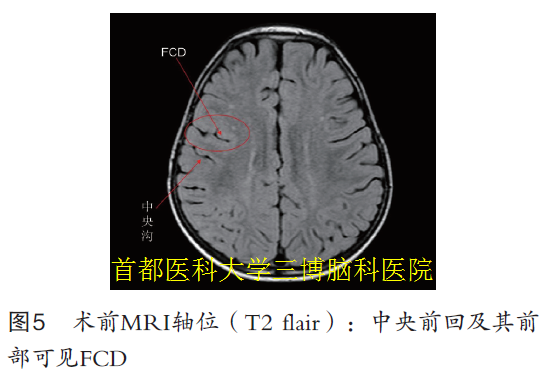 圖5 術(shù)前MRI軸位（T2 flair）：中央前回及其前 部可見FCD