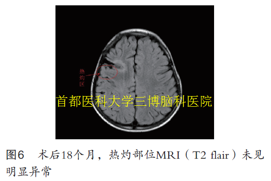 圖6 術(shù)后18個(gè)月，熱灼部位MRI（T2 flair）未見 明顯異常