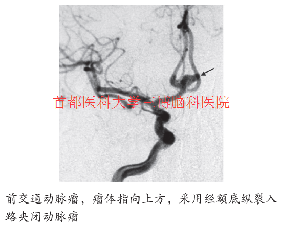 前交通動(dòng)脈瘤，瘤體指向上方，采用經(jīng)額底縱裂入 路夾閉動(dòng)脈瘤