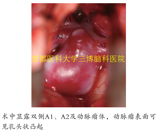 術(shù)中顯露雙側(cè)A1、A2及動(dòng)脈瘤體，動(dòng)脈瘤表面可 見乳頭狀凸起