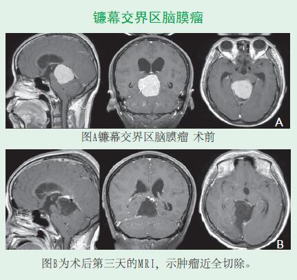 鐮幕交界區(qū)腦膜瘤