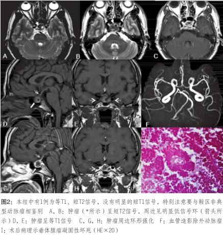 與鞍區(qū)非典 型動脈瘤相鑒別