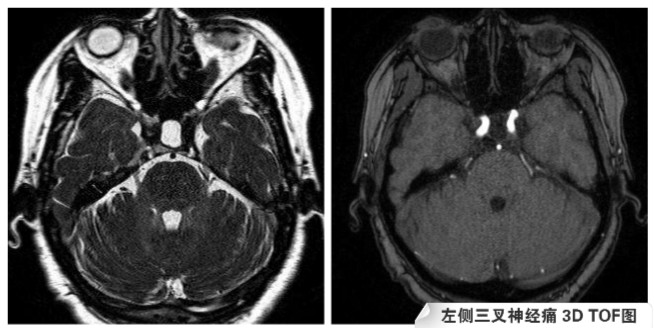 左側(cè)三叉神經(jīng)痛 3D TOF圖