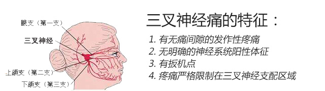 三叉神經(jīng)痛的確定診斷應具備下述4個特征