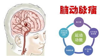 為什么會(huì)得腦動(dòng)脈瘤？腦動(dòng)脈瘤常見病因