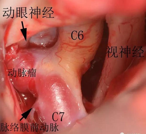 動(dòng)脈瘤