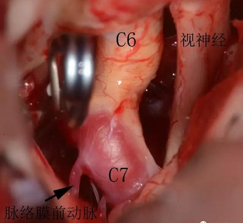 一枚動(dòng)脈瘤夾夾閉動(dòng)脈瘤瘤頸之后，動(dòng)脈瘤消失