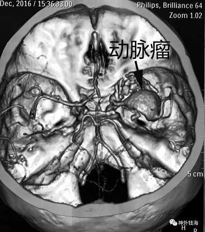 右顳部巨大動(dòng)脈瘤