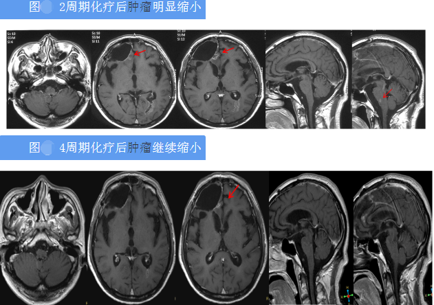 化療病例