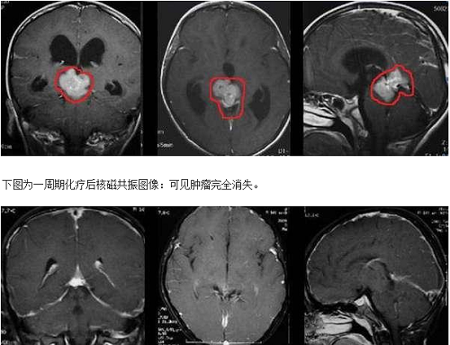 化療病例