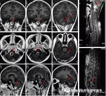 兒童延髓毛細(xì)胞型星形膠質(zhì)細(xì)胞瘤復(fù)發(fā)播散，該如何治療？