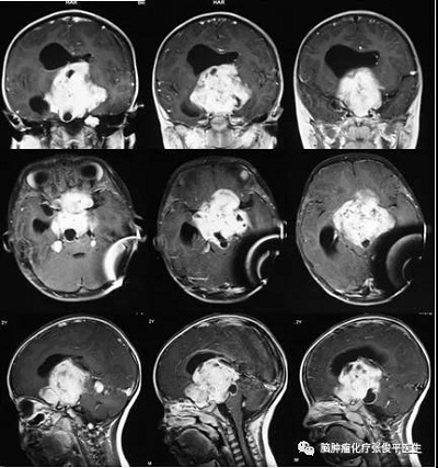 腫瘤由鞍區(qū)突入三腦室內(nèi)，并伴有后顱窩多處轉(zhuǎn)移