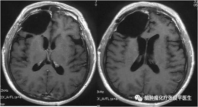 術(shù)后核磁，腫瘤全切