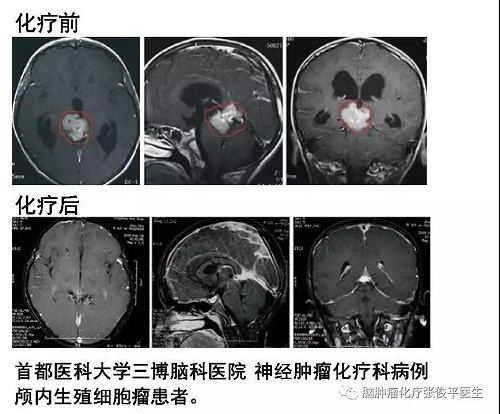 顱內(nèi)生殖細(xì)胞腫瘤的治療