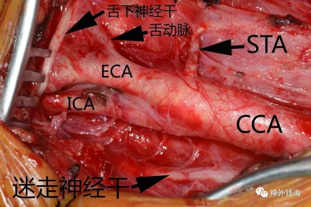 煙霧病術中照片，顯示相關結構