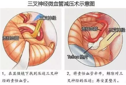 三叉神經(jīng)痛、面肌痙攣……MVD手術(shù)全搞定