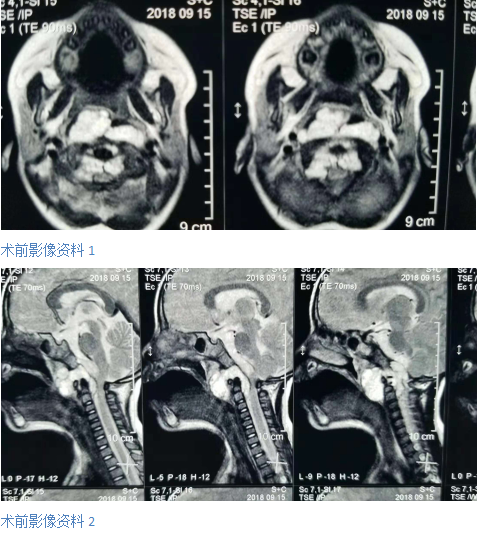 小孩子睡覺打鼾警惕藏有巨大危險(xiǎn)