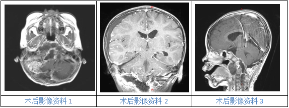 手術(shù)切掉了威脅琪琪的腫瘤