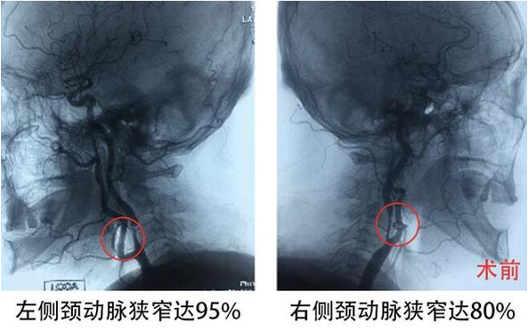 頸動脈被堵只?！耙痪€天” 外科微創(chuàng)疏通生命通道