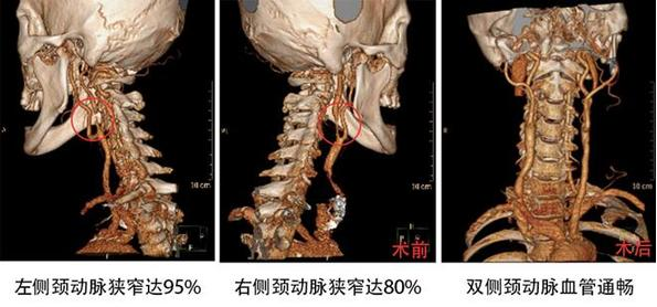 頸動脈被堵只?！耙痪€天” 外科微創(chuàng)疏通生命通道