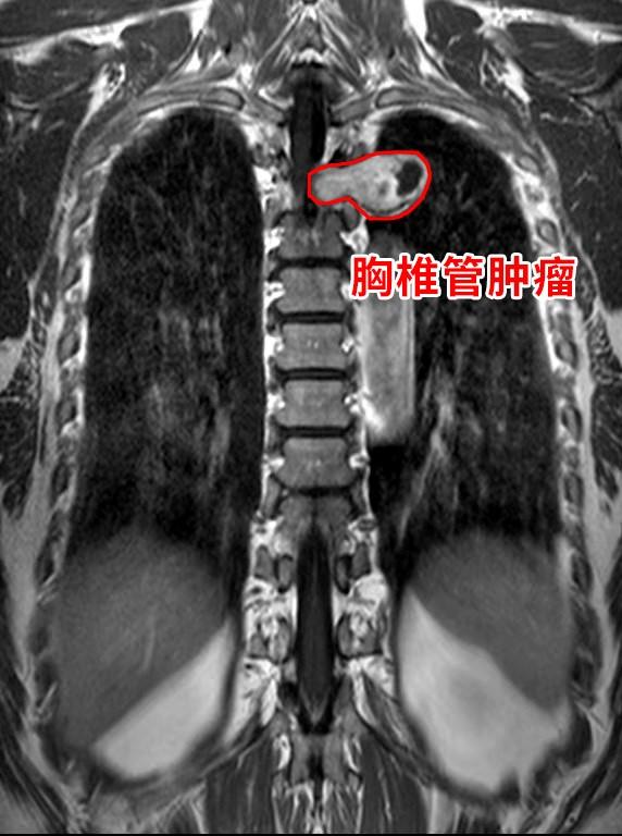 胸疼胸悶竟是胸椎腫瘤在作祟 取出腫瘤整個(gè)人都輕松了