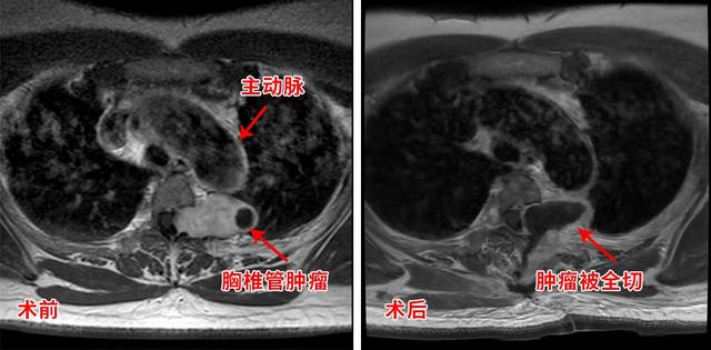 胸疼胸悶竟是胸椎腫瘤在作祟 取出腫瘤整個(gè)人都輕松了