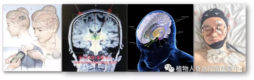 “植物人”真的無法醒過來嗎？這3種方法為昏迷促醒提供更多可能