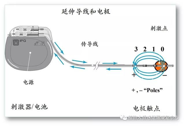 “植物人”真的無法醒過來嗎？這3種方法為昏迷促醒提供更多可能