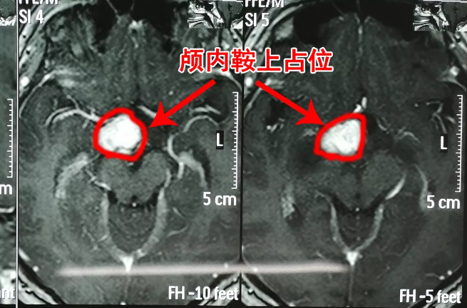 胸部變大的男孩，竟是因為腦中長了腫瘤