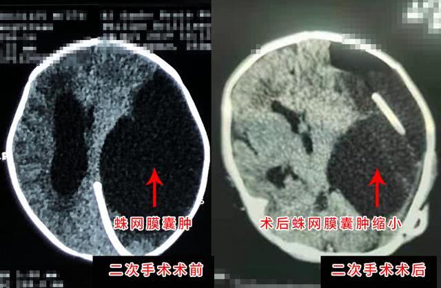 29天嬰兒巨大蛛網(wǎng)膜囊腫 三博腦科精準(zhǔn)手術(shù)疏通“水”路