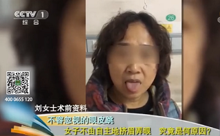 面肌痙攣：不容忽視的眼皮跳 女<